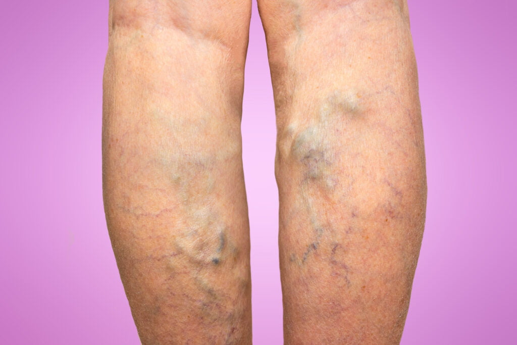 varicose veins 24-7 medcare