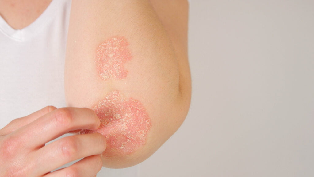 psoriasis 24-7 medcare