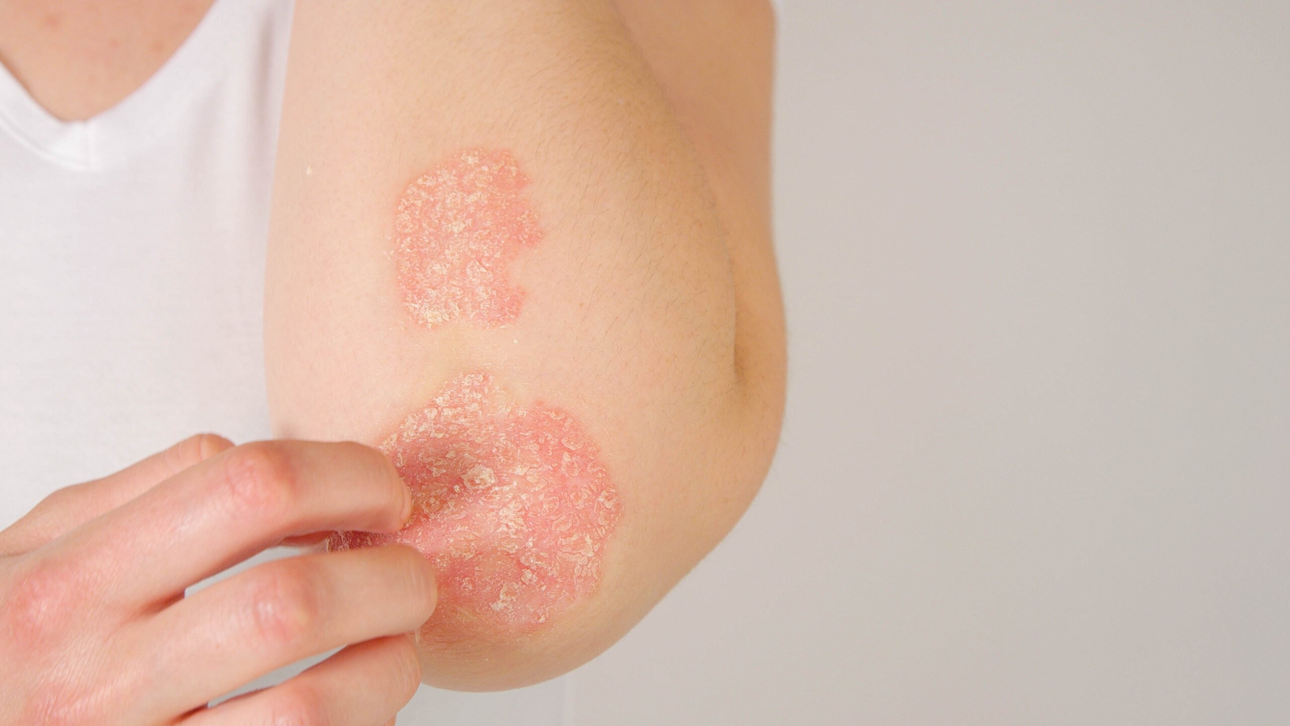 psoriasis 24-7 medcare